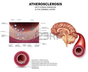 46343918-l-aterosclerosi-formazione-striscia-grassi-nelle-arterie-cerebrali