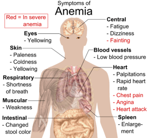Symptoms_of_anemia.png