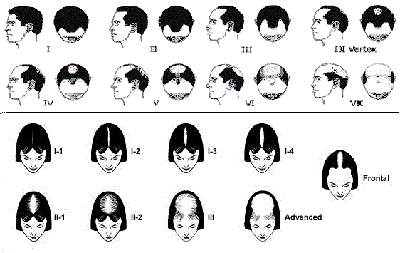 Alopecia-androgenetica-7