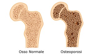 osteoporosi-cause