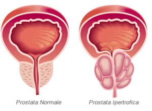 cancro-alla-prostata