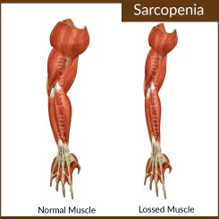 Sarcopenia