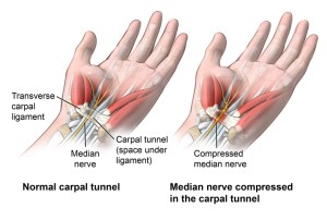 carpal-tunnel