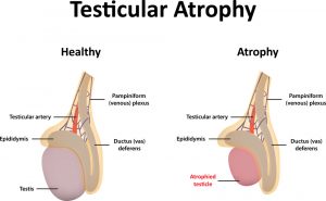 testicleatrofy