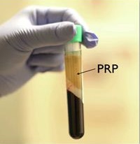 PRP-growth-factors-still