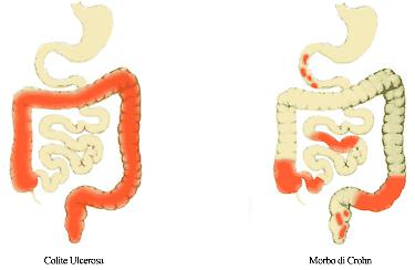 1503838360165.jpg--colite-ulcerosa-e-morbo-di-crohn-un-problema-per-250-mila-italiani
