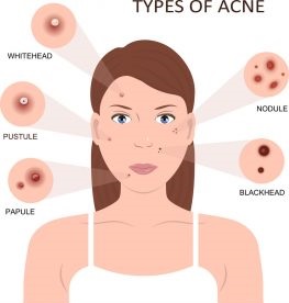 acne-vulgaris1-263x300