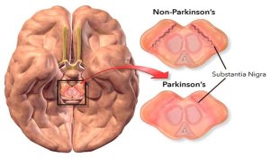 parkinsons_substantia_nigra