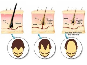 high level of DHT makes the hair strands to fall out faster LEWIGS