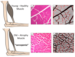 sarcopenia